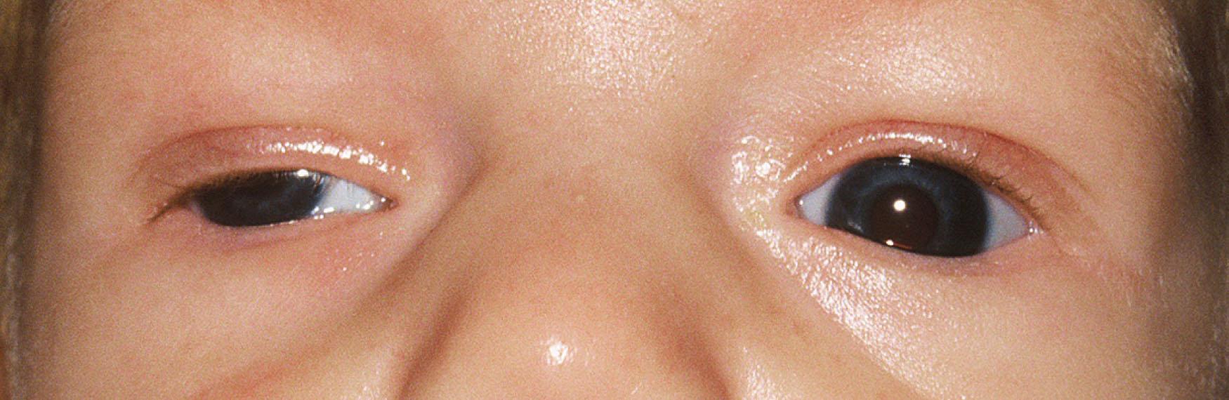 Fig. 85.2, Congenital right third nerve palsy. Clinical photograph of a baby with a right congenital third nerve palsy. Note the miosis of the involved pupil, which can be seen in congenital third nerve palsies.