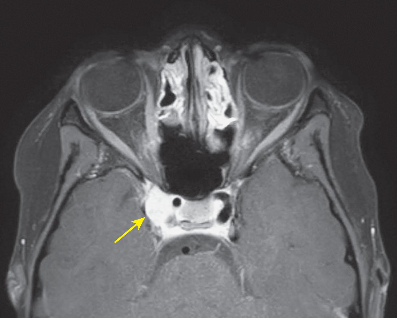 Fig. 85.3, Acquired partial right third nerve palsy. Axial T1-weighted fat-suppressed magnetic resonance imaging scan revealing a right cavernous sinus hemangioma (yellow arrow) in a patient with a partial right third nerve palsy.