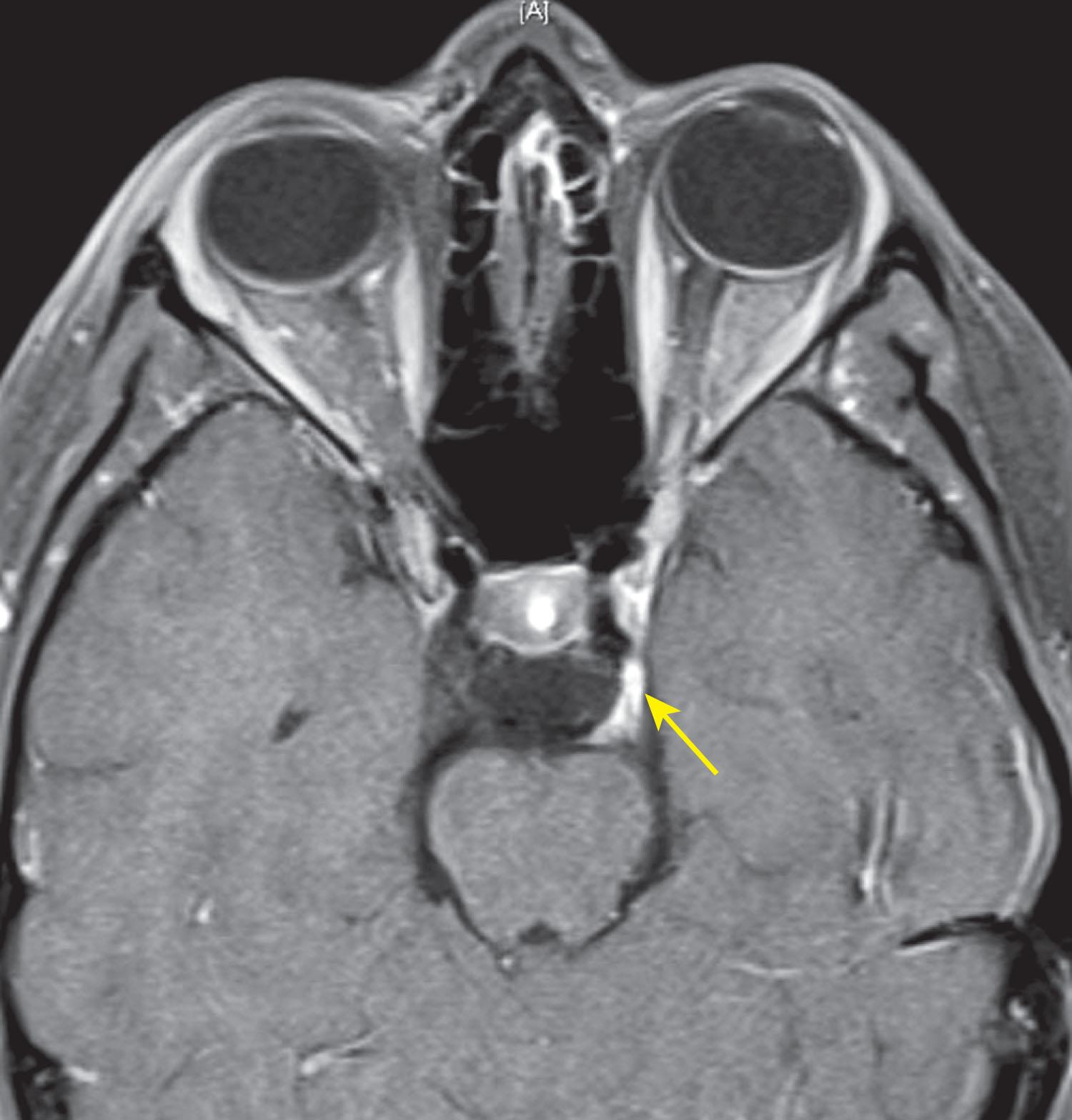 Fig. 85.4, Recurrent left third nerve palsy. Axial T1-weighted fat-suppressed magnetic resonance imaging scan revealing enhancement of the left third nerve (yellow arrow) in a patient with recurrent painful left third nerve palsy.