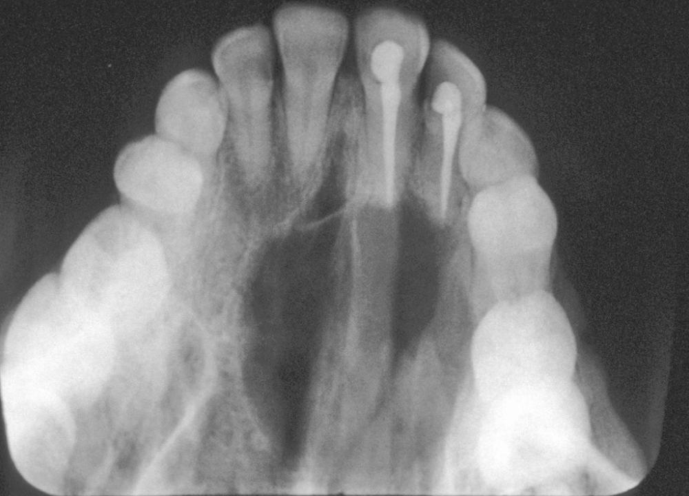 Fig. 88.1, Occlusal radiograph of large periapical cyst associated with two endodontically treated maxillary incisors.