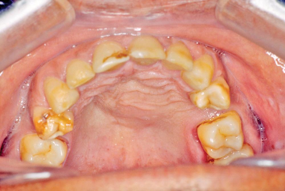 Fig. 88.3, Clinical photograph of cyst seen in Fig. 88.1 before enucleation.