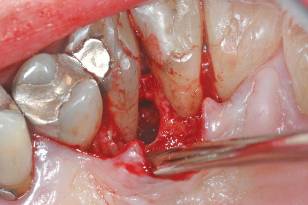Fig. 88.4, Intraoperative photograph of an inflammatory collateral cyst. Tooth is vital with periodontal pocket leading to intrabony cystic area.