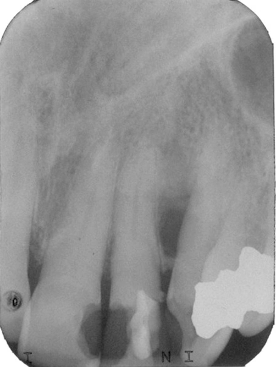 Fig. 88.5, Radiograph of inflammatory collateral cyst.