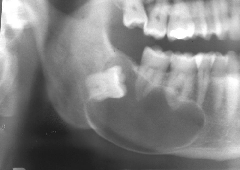 Fig. 88.6, Radiograph of large dentigerous cyst associated with molar crown.