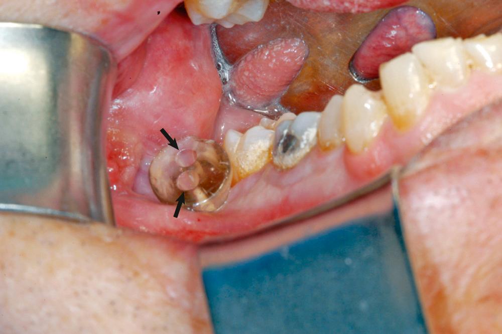 Fig. 88.7, Clinical photograph of device used for cyst decompression. Note two holes to allow for proper irrigation.