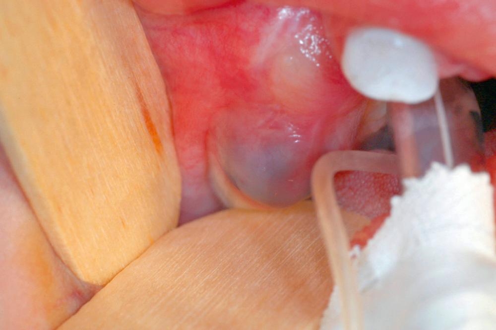 Fig. 88.8, Clinical photograph of maxillary eruption cyst in an infant found incidentally.