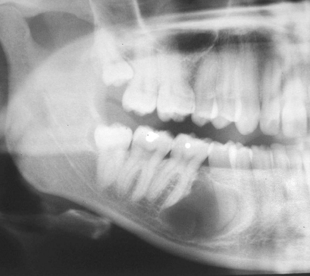 Fig. 88.9, Radiograph of an odontogenic cyst of undetermined origin.