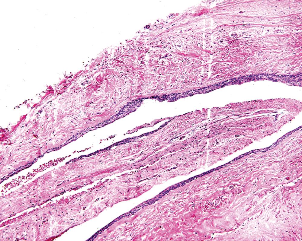 Fig. 88.10, Photomicrograph of generally thin cyst lining typical of the lateral periodontal cyst.