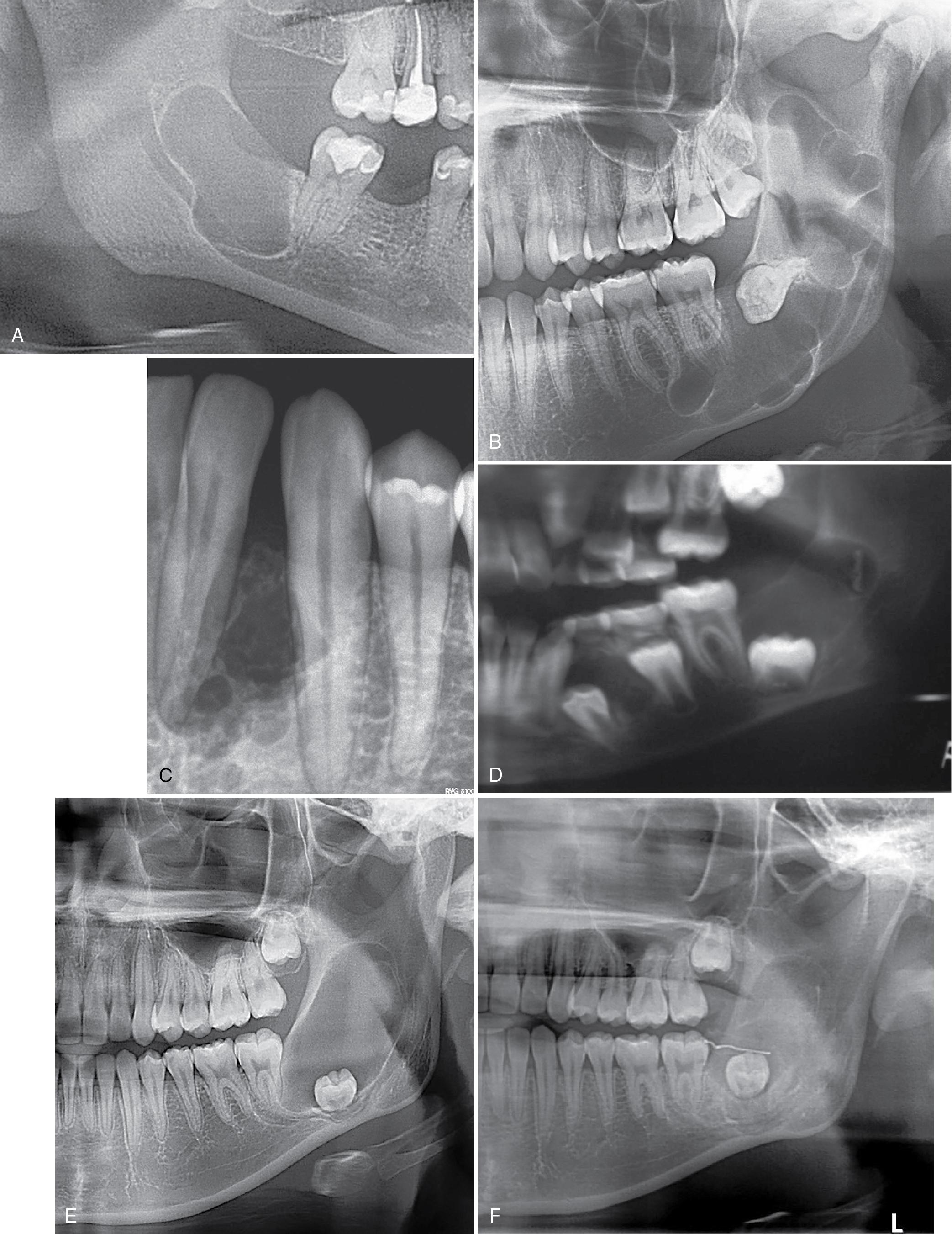 FIG. 15.2, KCOT/OKC. (A) Unilocular radiolucency of the right posterior mandible. (B) Multilocular radiolucency of the left mandible. (C) Multiloculated radiolucency between two vital teeth noted on periapical film. (D) Anterior and left mandibular cystic tumors overlying impacted teeth in a child with nevoid basal cell carcinoma syndrome. (E) Large delineated unilocular radiolucency overlying impacted third molar before marsupialization and (F) after marsupialization with bone fill. KCOT/OKC, Keratocystic odontogenic tumor/odontogenic keratocyst.