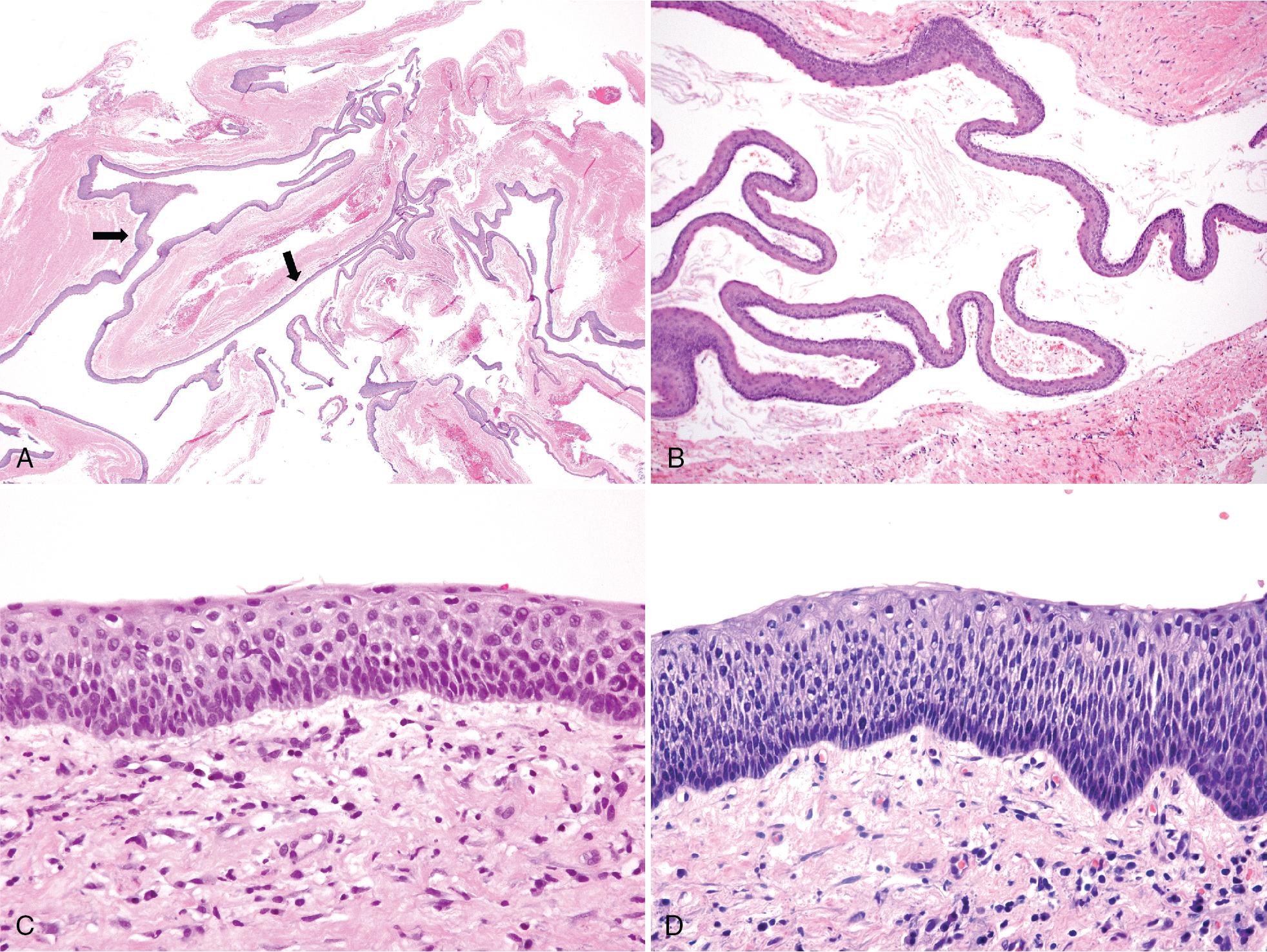 FIG. 15.3, KCOT/OKC. (A) Typical appearance of cystic tumor with thin lining and fibrous wall with little inflammation. Cyst lined by uniformly thin epithelium with multifocal areas of epithelial detachment (arrows) . (B) Detached strips of lining epithelium exhibit surface corrugations, parakeratosis, and prominent basal cells. (C) Lining is 5 to 10 cells thick with minimal parakeratin and palisaded basal cell nuclei. (D-E) Lining epithelium appears dysmature with marked basal cell hyperplasia (F) Lining shows budding of the basal cells, and there are satellite cysts and keratin pearls within satellites. (G) Dysmature hyperplastic lining exhibiting hyperchromasia and cells with increased nuclear:cytoplasmic ratio consistent with epithelial dysplasia. KCOT/OKC, Keratocystic odontogenic tumor/odontogenic keratocyst.