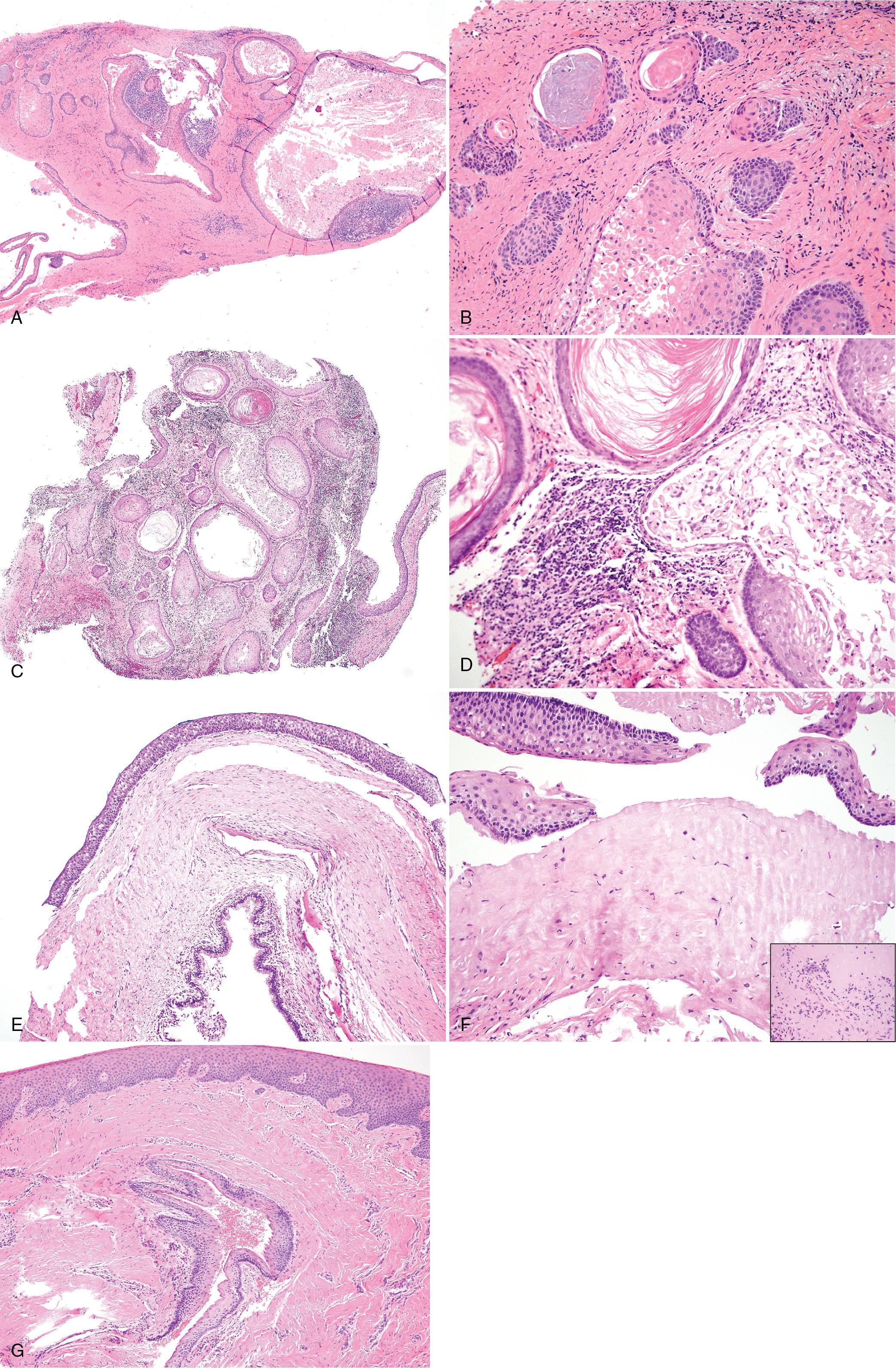 FIG. 15.5, (A-D) KCOT/OKC with satellite cysts. (A) Many satellite cysts of varying sizes are present in the wall. (B) Satellite cysts may form keratin pearls and should not be mistaken for development of a squamous cell carcinoma. (C and D) Some satellite cysts exhibit macrophages within the lumen. (E) Perforation into the sinus is a common finding. (F) Cartilage in the wall of the lesion with a multinucleated giant cell (inset) . (G) Peripheral KCOT/OKC within the superficial and deep lamina propria of the mucosa. KCOT/OKC, Keratocystic odontogenic tumor/odontogenic keratocyst.