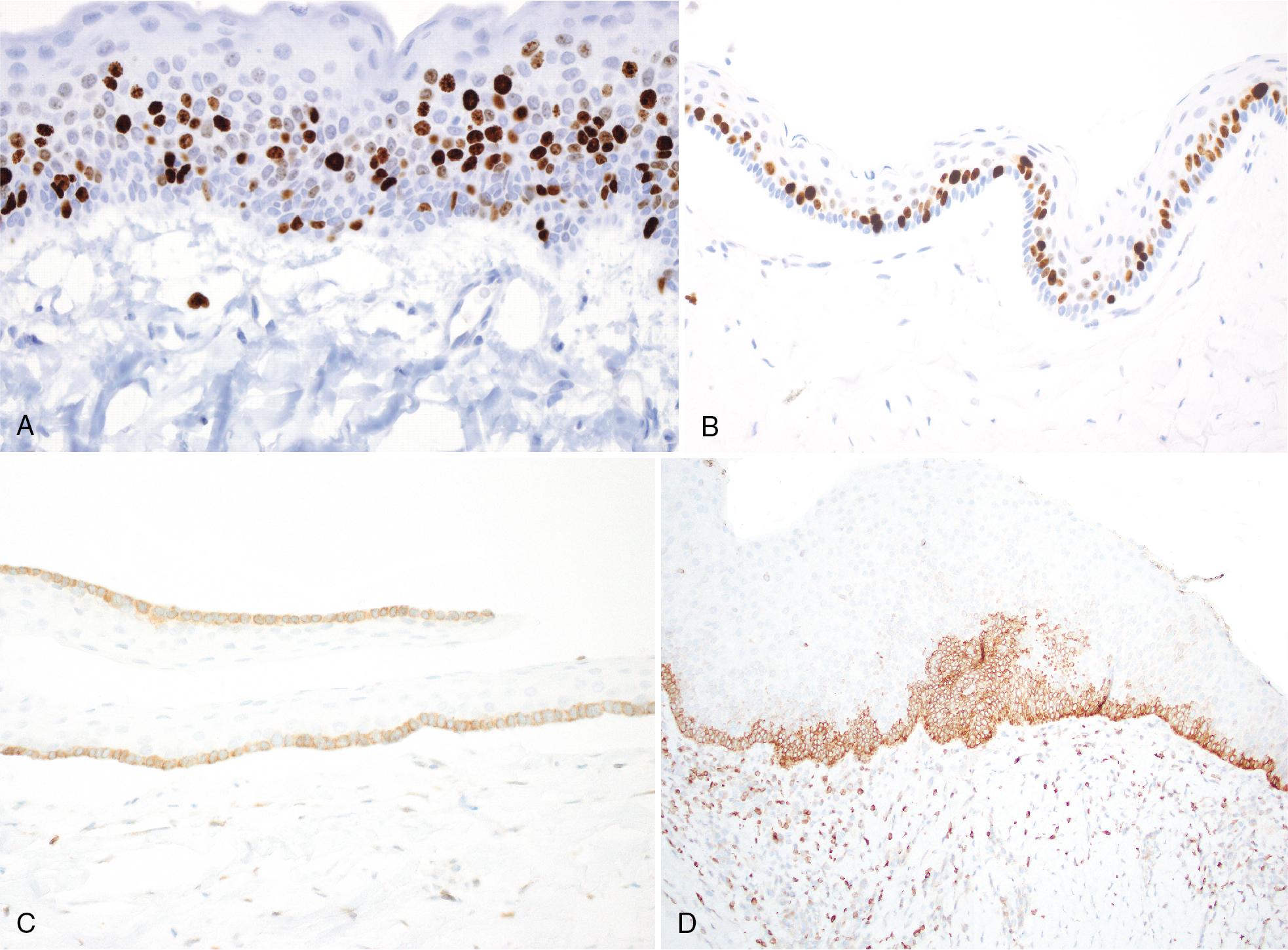 FIG. 15.6, (A) KCOT/OKC exhibits Ki67 positive cells either scattered throughout the thickness of the epithelium in 30% to 40% of cells, or (B) in the parabasal cells. (C) Positivity for BCL2 is noted within the basal cells. (D) Positivity for BCL2 may be multi-layered in areas of basal cell hyperplasia. KCOT/OKC, Keratocystic odontogenic tumor/odontogenic keratocyst.