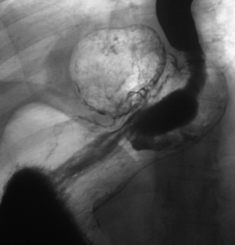 Contrast study demonstrating a combined-type hiatus hernia. Note the rolling component with a large portion of stomach above the diaphragm, but in addition the gastro-oesophageal junction has also migrated cranially. *