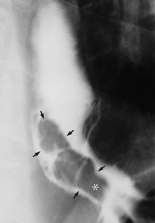 Inflammatory polyp (arrows) lying at end of gastric fold (asterisk). †