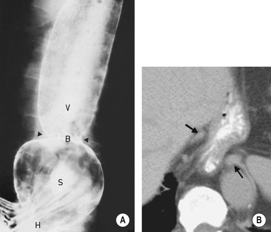 Sliding hiatus hernia. (A) Barium swallow shows a hiatus hernia (H), more than 3-cm wide with at least 3 gastric folds seen extending across it ▸ S = stomach forming the hernia ▸ B = B ring, the gastro-oesophageal junction ▸ V = vestibule. The A ring is not visible. (B) CT scan showing the crura of the diaphragm (arrows) separated by 28 mm (normal is <15 mm). The fundus of the stomach is seen herniating through the diaphragmatic hiatus. †