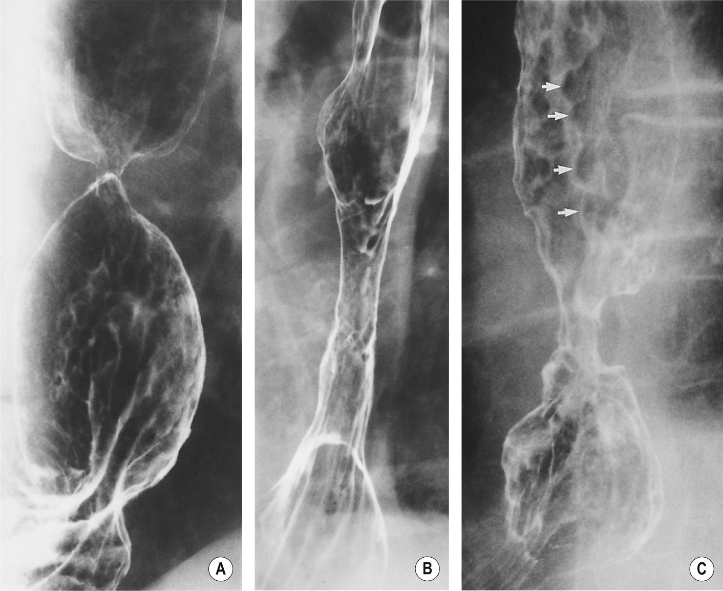 An annular peptic stricture at the GOJ. (A) An area gastricae pattern is present below the stricture. (B) Benign peptic stricture above a hiatus hernia. The stricture has smooth tapered margins. (C) Benign peptic stricture. Asymmetric ulceration and scarring has produced a stricture with irregular and shoulder margins resembling a carcinoma. Erosions on the oesophageal folds give them a lobular margin resembling varices (arrows). †