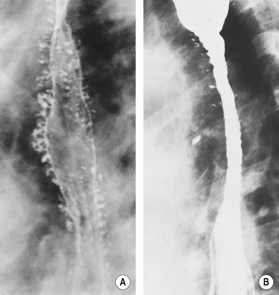 Intramural pseudodiverticulosis. (A) Multiple flask-shaped projections produced by barium entering dilated oesophageal glands. (B) Mid-oesophageal stricture with small flask-shaped projections. †