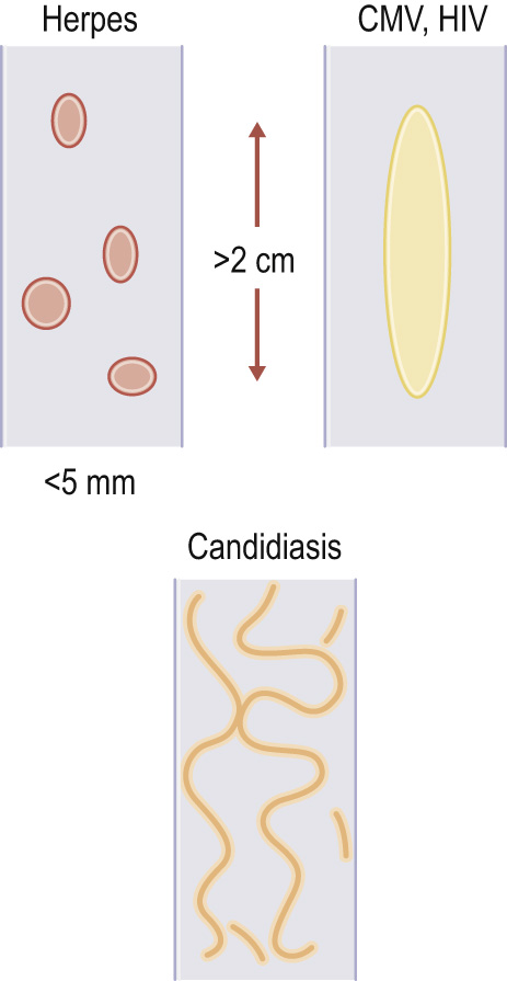 Diagrammatic representation of oesophageal ulceration.