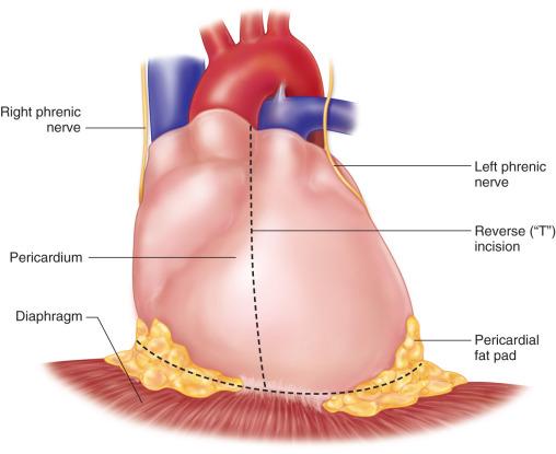 Figure 4.1, Inverted-T pericardial incision.