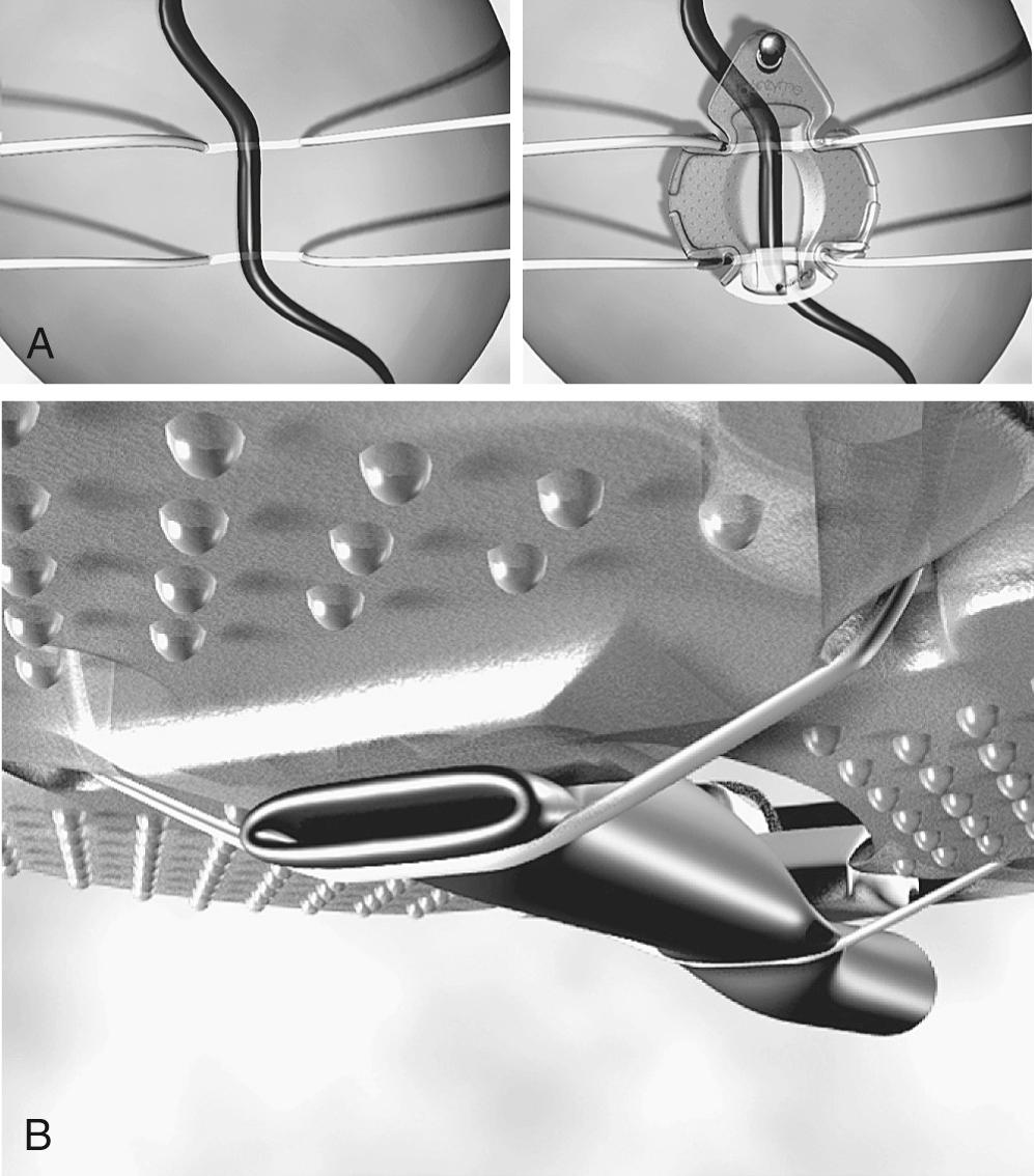 FIGURE 89-3, Capture-type stabilizers use silicone elastic tapes to ensure tight apposition of the textured surface of the footplate and the epicardial surface. This arrangement results in integrated coronary compression. A, The surgeon's view of a coronary vessel in a capture-type stabilizer demonstrating spacing of the silicone elastic tapes. B, Simulated view of the coronary vessel segment from the underside of the stabilizer.