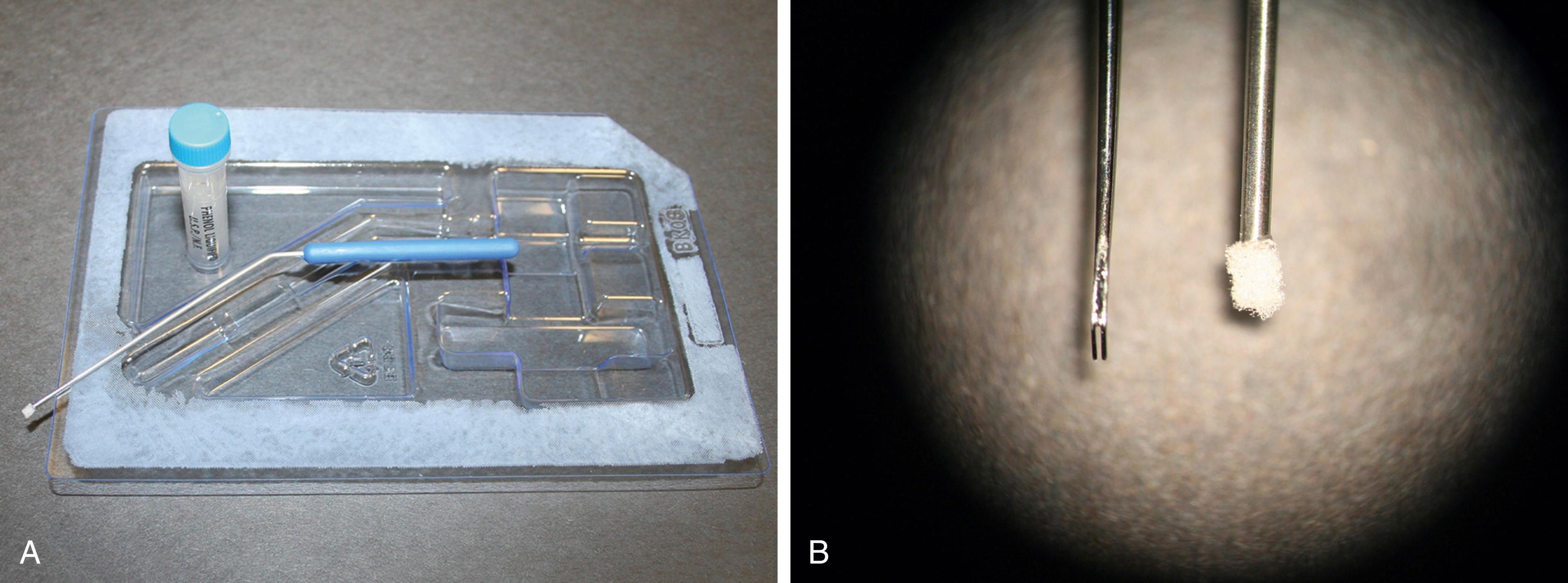 Fig. 125.1, Options for application of phenol to the tympanic membrane.