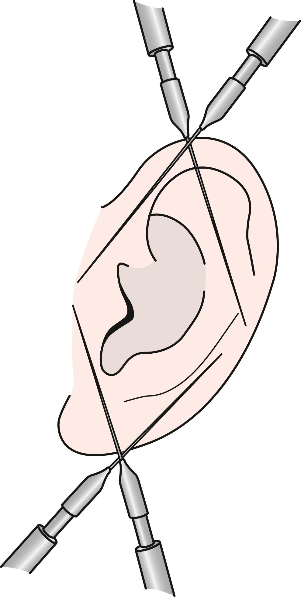 Fig. 125.3, Regional block of the pinna and external ear.