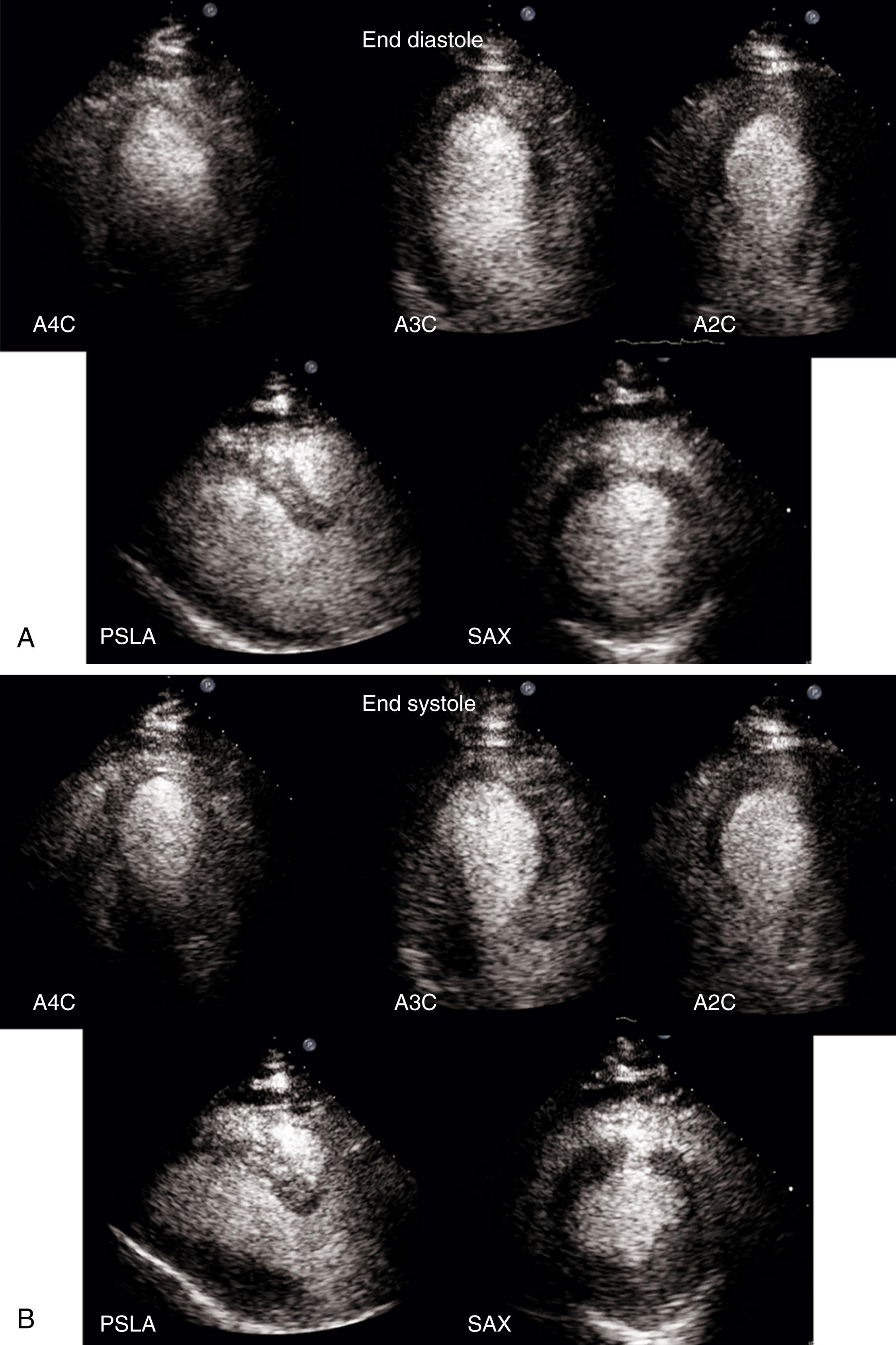 Figure 45.1, Acute left descending coronary (LAD) transmural infarct in a patient who underwent emergent revascularization with no reflow. End-diastolic ( A ) and end-systolic ( B ) transthoracic echocardiography (TTE) images show large area of akinesis in the LAD territory. Accompanying Video 45.1A , Video 45.1B , Video 45.1C , Video 45.1D , Video 45.1E show the apical four-chamber (A4C), apical three-chamber 3C (A3C), apical two-chamber (A2C), parasternal long-axis (PSLA), and parasternal short-axis (SAX) TTE views, respectively. C, Delayed contrast-enhanced cardiac magnetic resonance image shows a transmural LAD infarct ( bright areas) with severe microvascular obstruction (dark endocardial areas) extending throughout the whole thickness of the infarct (arrows).