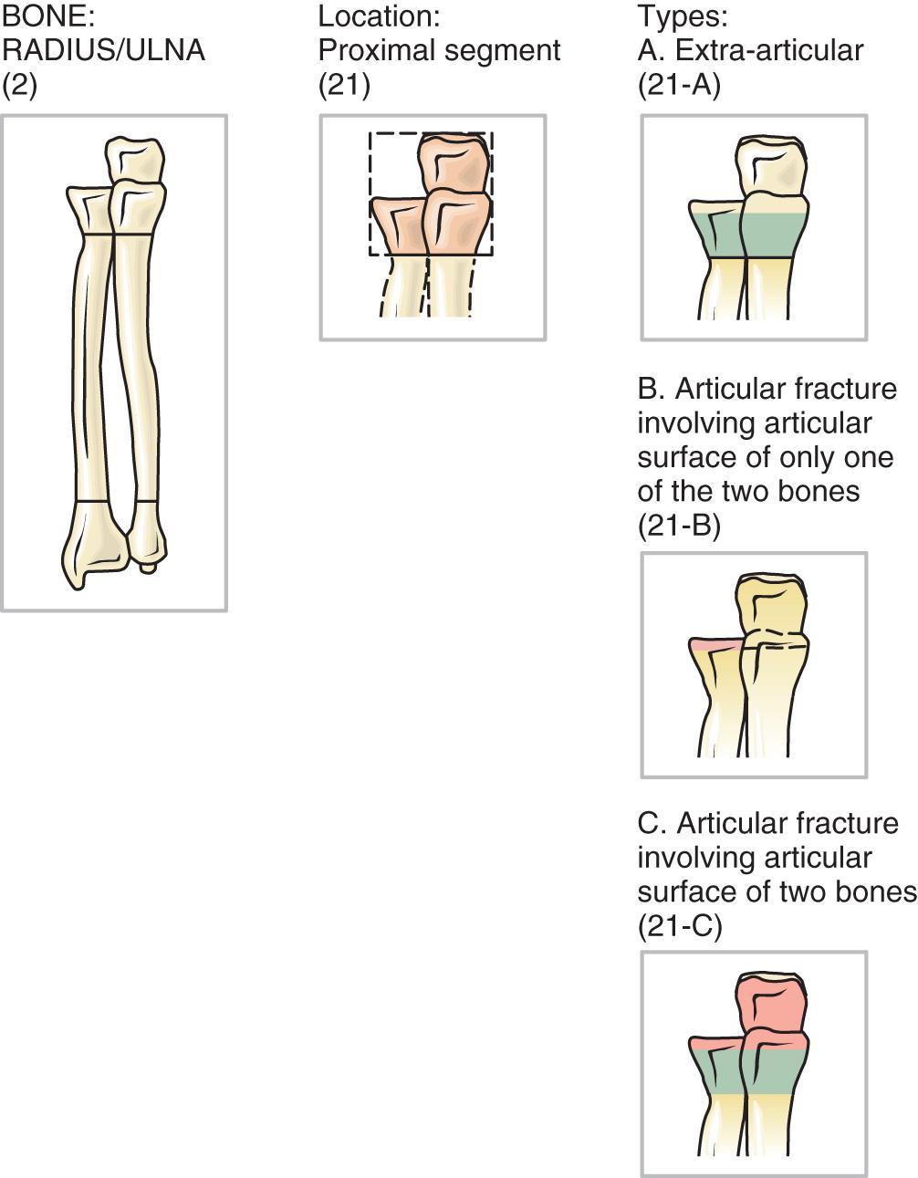 FIG 42.1, The AO classification accounts for fractures of both the proximal radius and ulna as fracture site (2) for radius/ulna, and (21) for the proximal segment of the radius and ulna. Type A fractures are extraarticular, type B fractures are intraarticular fractures involving the articular surface of either the radius or the ulna, and type C fractures are those involving the articular surface of both bones. Additional subtypes denote comminution, displacement, and location.