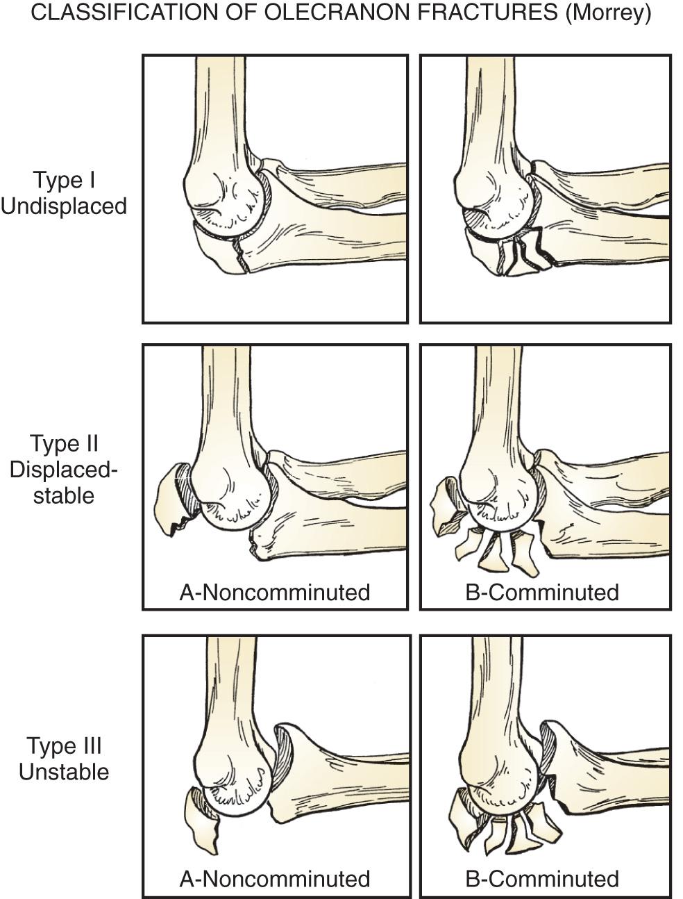 FIG 42.2, Mayo classification of olecranon fractures. Type I fractures are nondisplaced noncomminuted (IA) or comminuted (IB) fractures. Type II fractures are stable displaced fractures and may be noncomminuted (IIA) or comminuted (IIB). Type III fractures are unstable displaced fractures and may be noncomminuted (IIIA) or comminuted (IIIB).