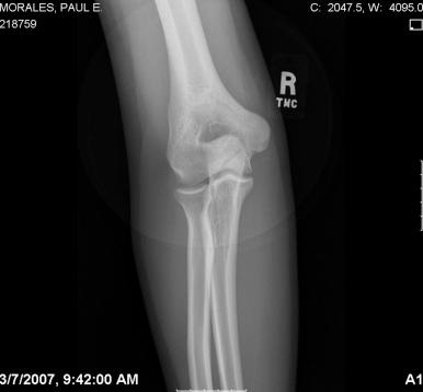 Fig. 33.1, Anteroposterior view of the elbow with an oblique fracture line noted.