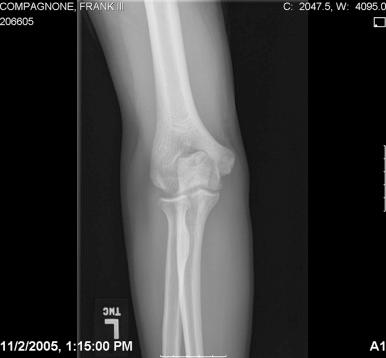 Fig. 33.2, Midproximal oblique olecranon stress factor before ORIF.