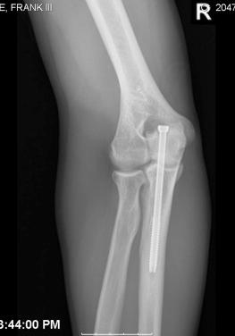 Fig. 33.3, Midproximal oblique olecranon stress fracture after ORIF.