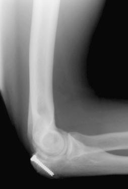 Fig. 33.5, Proximal transverse olecranon stress fracture after ORIF.