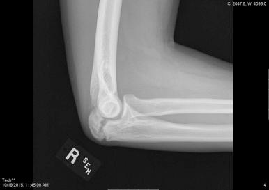 Fig. 33.6, Delayed olecranon physeal closure.