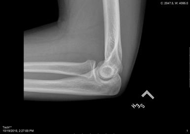 Fig. 33.7, From patient with delayed olecranon physeal closure in Fig. 33.6 , the contralateral elbow for comparison.