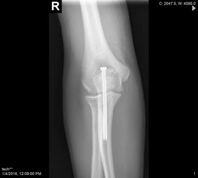 Fig. 33.9, Anteroposterior view of the elbow after ORIF.