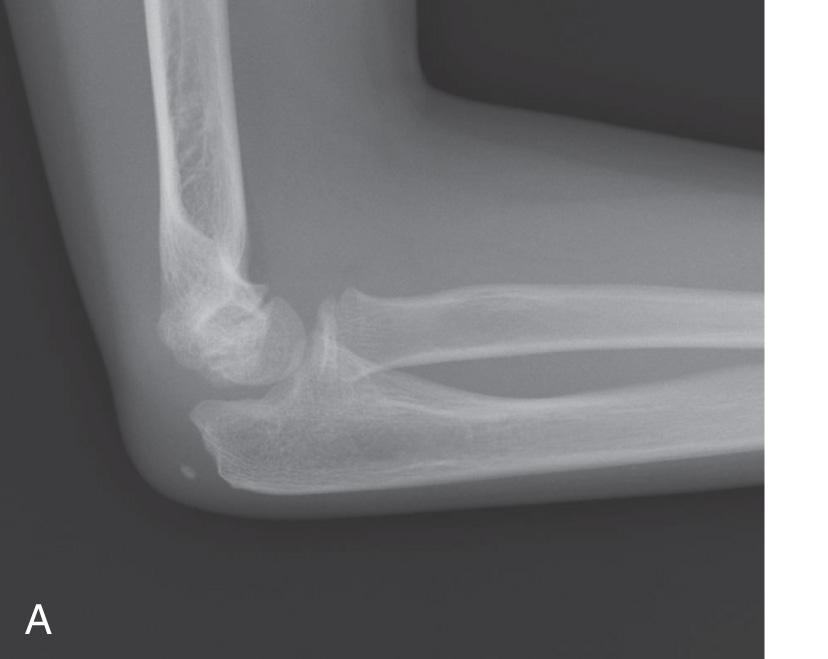 FIG 31.1, Ossification of the olecranon. (A) The primary apophyseal ossification center appears first, usually around 9 years of age. (B) This is followed by ossification of the epiphyseal ossification center. (C) The apophysis is last to close, giving the impression of an incomplete olecranon fracture.