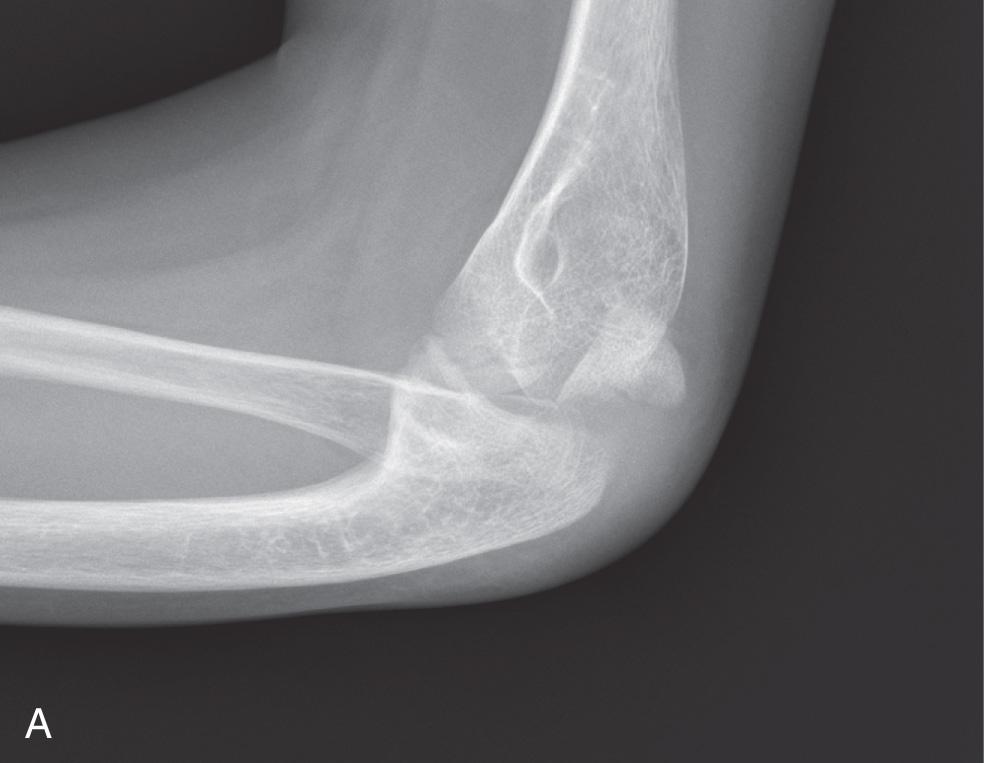 FIG 31.2, Olecranon sleeve fracture. (A) Apophyseal fracture of the olecranon in a patient with osteogenesis imperfecta. (B) This was treated with pins and tension band suture.