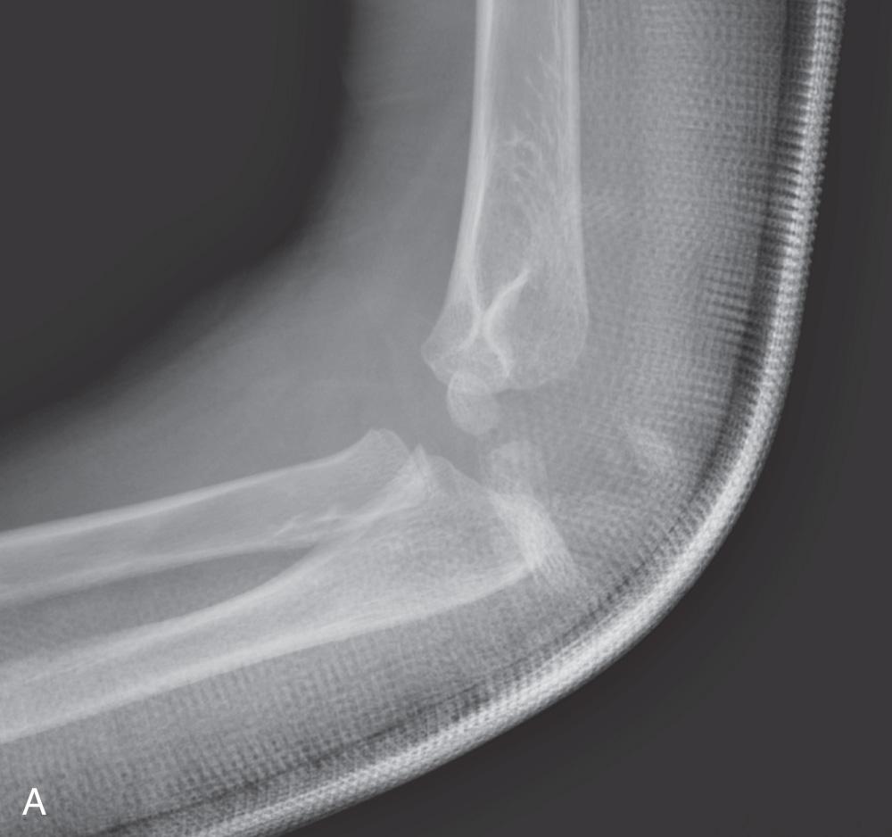 FIG 31.3, Transolecranon fracture–dislocation. (A,B) Diagnosis of a trans-olecranon fracture–dislocation can be difficult in the young child. (C) The extent of edema suggests a higher energy injury than is typical for an olecranon fracture. (D) An arthrogram can help to make the diagnosis. (E) In this case, the coronoid fracture was repaired through the olecranon fracture, and the olecranon fracture was fixed with pins and tension band suture. (F,G) At 4 weeks, a repeat arthrogram with examination under anesthesia was performed to verify a concentric stable reduction and the pins were removed.