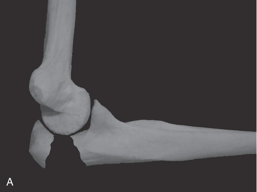 FIG 31.4, Proximal ulnar fracture types. (A) Olecranon fracture. (B) Transolecranon fracture–dislocation. (C) Monteggia fracture.