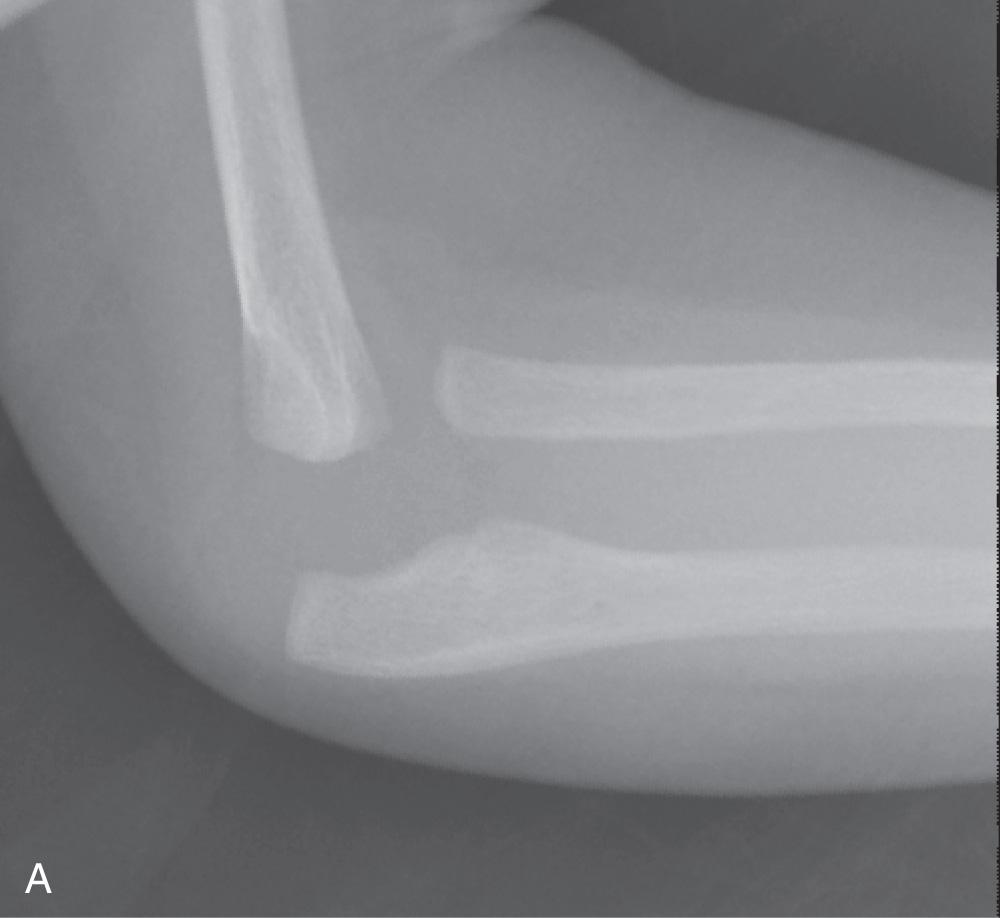 FIG 31.6, Monteggia fracture variant with plastic deformation. (A) Birth Monteggia fracture variant with plastic deformation of the ulna. (B) Arthrogram confirmed radial head dislocation at 14 months of age. (C) An ulnar osteotomy and gradual lengthening with an external fixator resulted in a stable reduction 2 years later on plain film (D) and arthrogram (E).