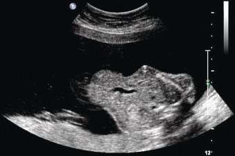 Fig. 21.1, Omphalocele with extracorporeal liver seen in transverse view at 21 weeks' estimated gestational age. The diagnosis was Beckwith-Wiedemann syndrome.