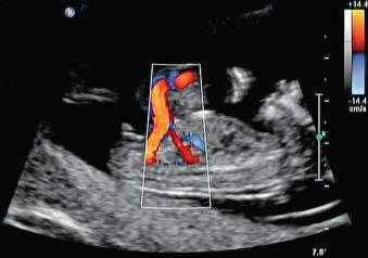 Fig. 21.4, Umbilical vessels coursing through the fetal omphalocele seen in sagittal view at 13 weeks' estimated gestational age.