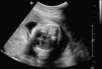 Fig. 21.5, Levorotated cardiac axis in a 29-week fetus with omphalocele and extracorporeal liver.