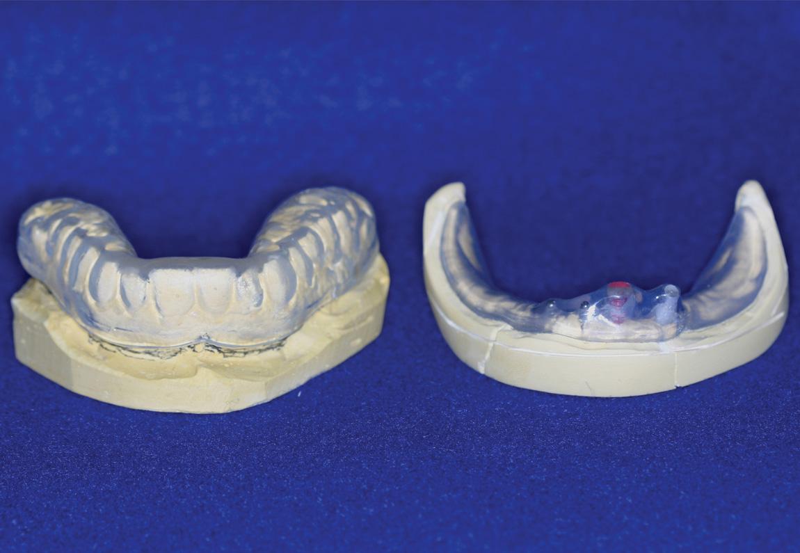 Figure 18.1, Customized mouthguards for a dentate patient ( left ) and an edentulous patient with implants ( right ).