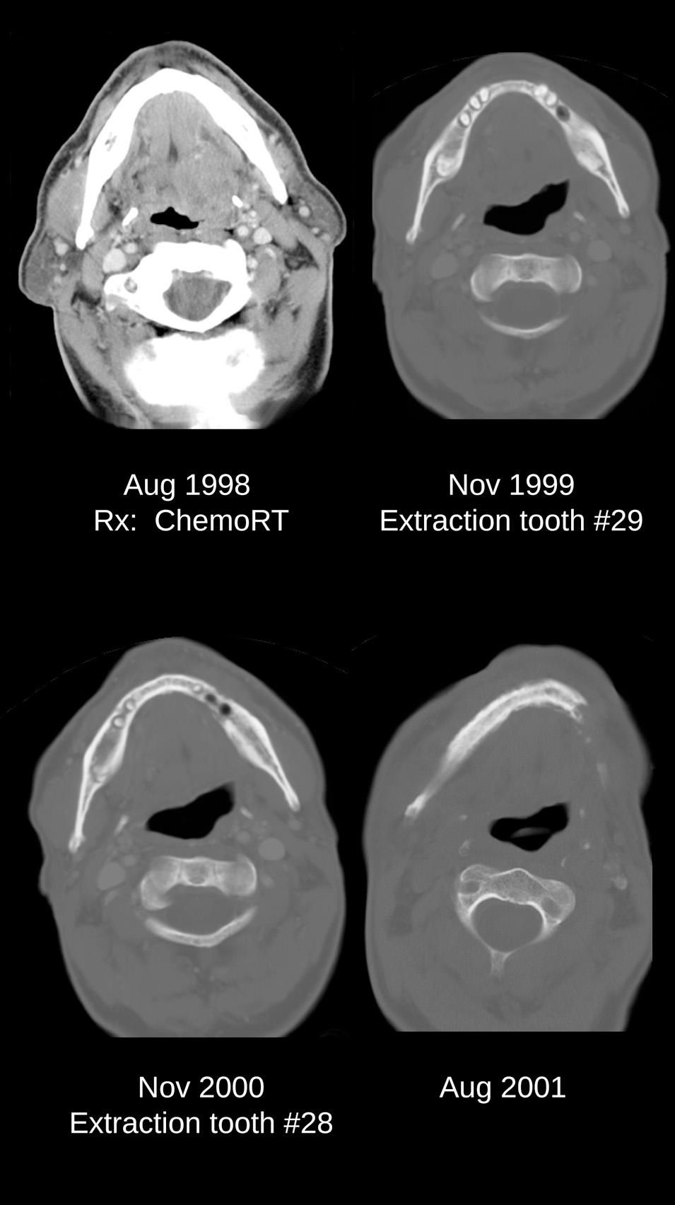 Figure 18.4, Serial computed tomography scans showing the initiation and progression of osteoradionecrosis after dental extraction.