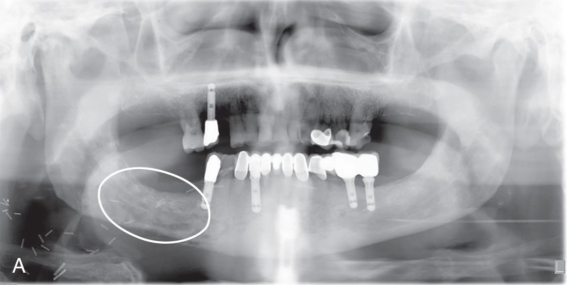 Figure 18.5, A , A panoramic radiograph of a patient with osteoradionecrosis of the jaw before pentoxifylline treatment. B , A panoramic radiograph of same patient 2 years later after pentoxifylline treatment, with an increase in bone density and fill of the defects.