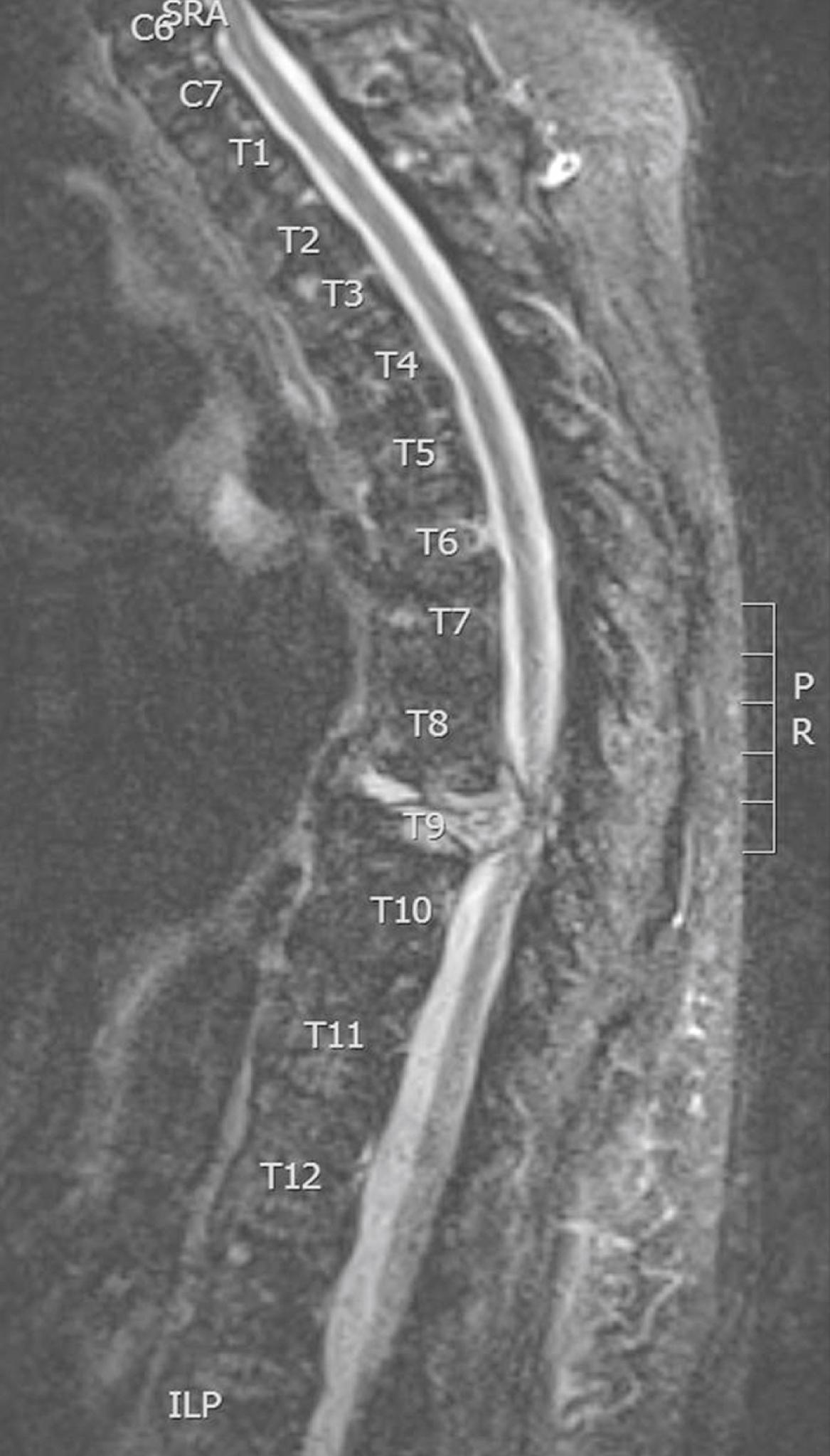 Fig. 112.1, Magnetic resonance imaging (MRI) short tau inversion recovery (STIR) image of T9 vertebral malignancy with pathologic fracture causing spinal cord compression in a patient with multiple myeloma. Vertebral numbering as marked.