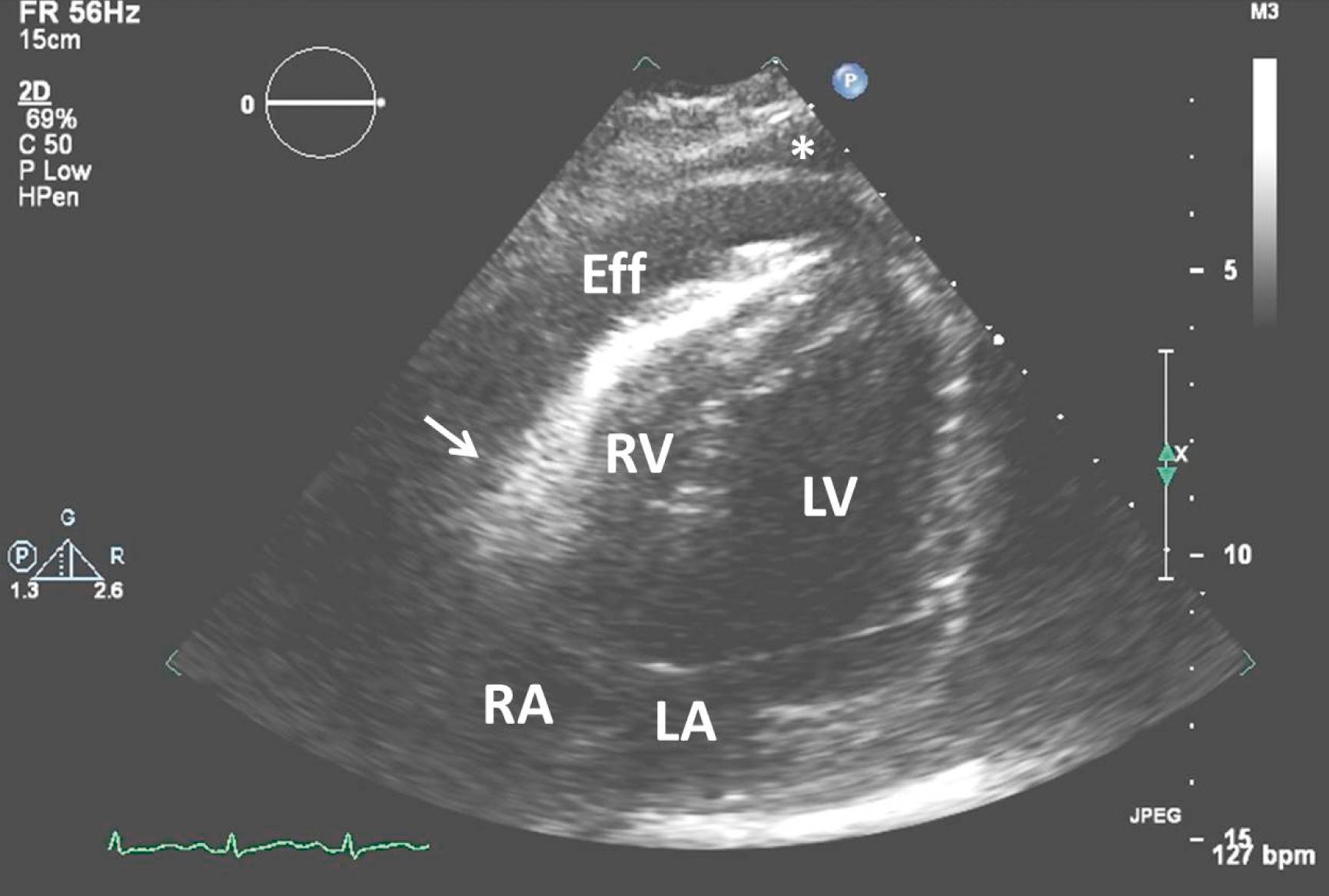 Fig. 112.2, Four-chamber apical view demonstrating pericardial effusion (Eff) with tamponade physiology in a patient with breast cancer. Buckling of the right ventricle wall is marked by a white arrow. Left ventricle (LV), left atrium (LA), right ventricle (RV), and right atrium (RA) are all as marked. Incidentally noted pleural effusion is marked with an asterisk (∗).