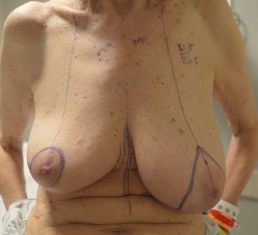 Fig. 13.1, Preoperative image demonstrating a woman with right breast cancer scheduled for oncoplasty via a circumlateral incisional pattern and a left reduction mammaplasty for symmetry.